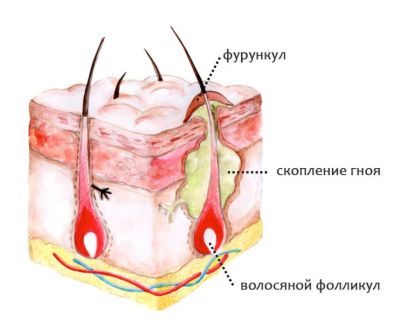 Абсцесс